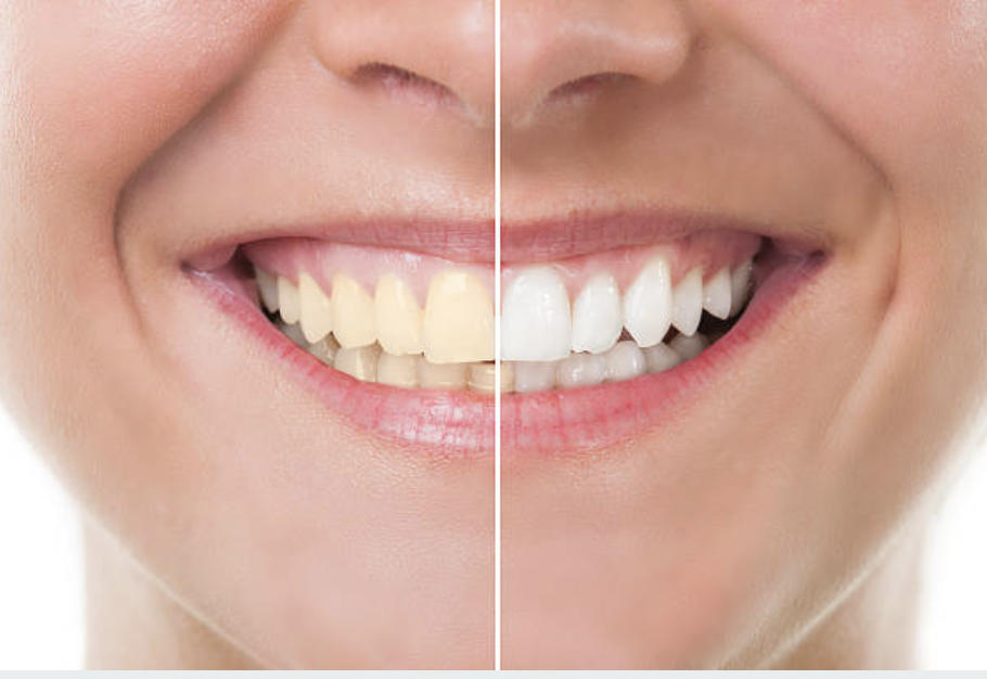 Imagen ilustrativa de una sonrisa saludable y dientes con un antes y después, representando los métodos para eliminar el sarro en poco tiempo.
