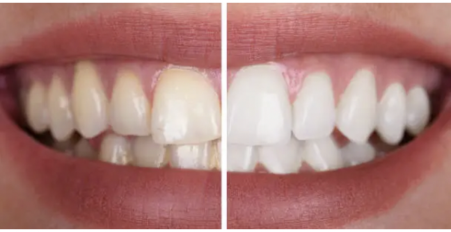 Blanquear los dientes amarillos en cuestión de minutos es algo muy complicado. A pesar de ello, hay métodos que pueden ayudarte de forma rápida a lograrlo.